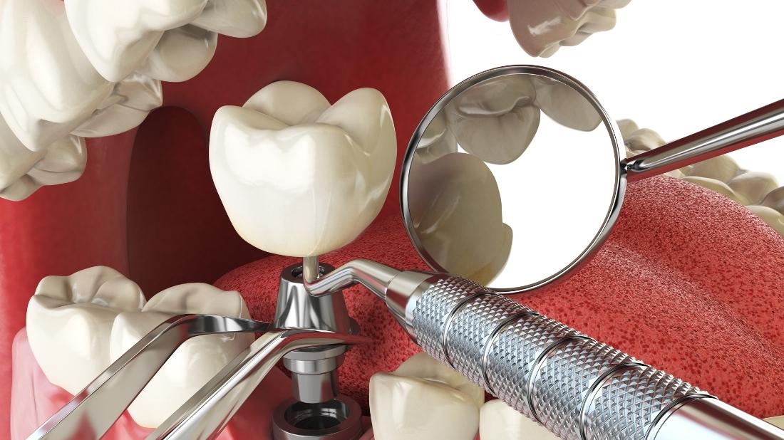Price and reimbursement of dental implants in Morocco